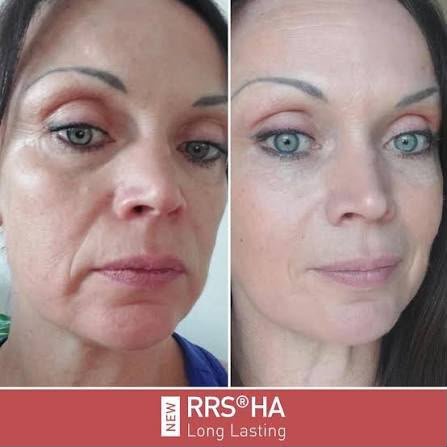 ابرة نضارة RRS long lasting